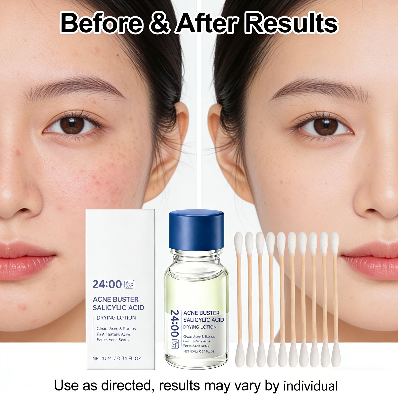Salicylic Acid Drying Lotion A - Azelaic Acid Cream reseña y precio