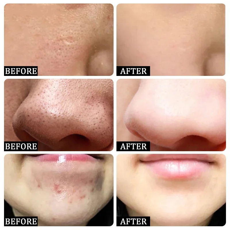 Salicylic Acid Pore Clearing C - Azelaic Acid Cream reseña y precio