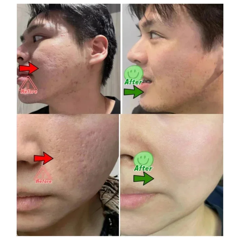 Salicylic Acid Pore Clearing C - Azelaic Acid Cream reseña y precio