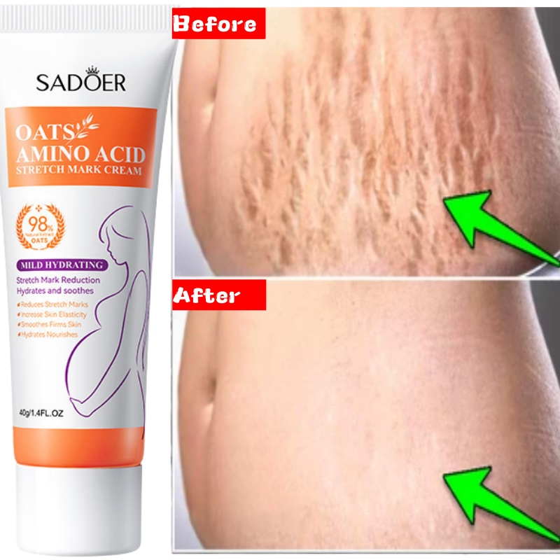 Stretch Marks Permanent Remova - Skincare Oat reseña y precio