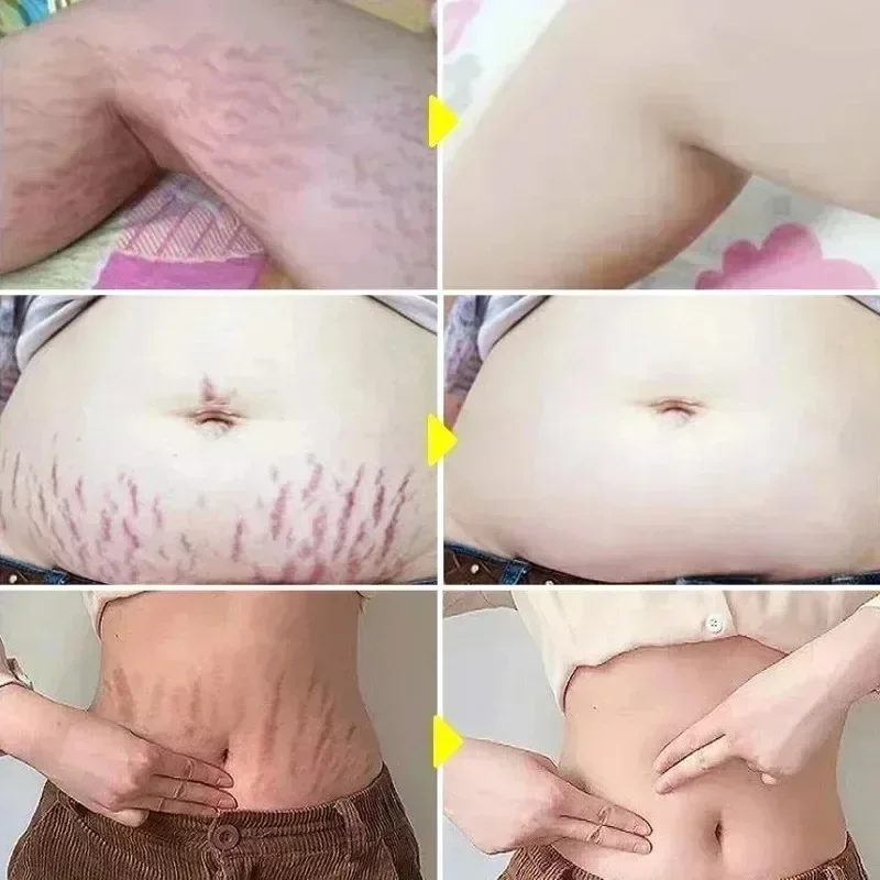 Stretch Marks Permanent Remova - Skincare Oat reseña y precio