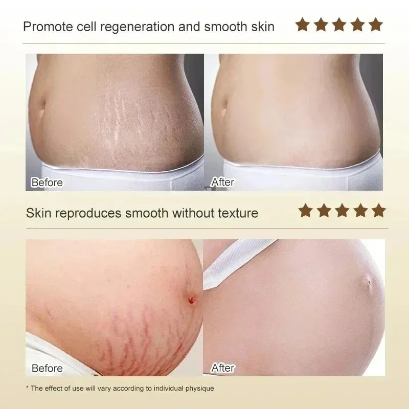 Stretch Marks Permanent Remova - Skincare Oat reseña y precio