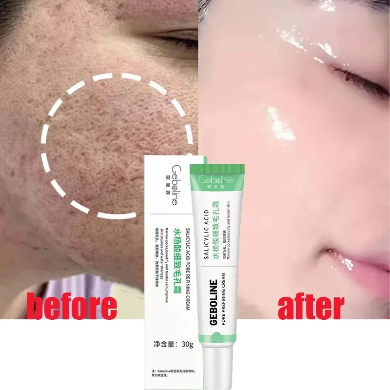 Salicylic Acid Pore Shrinking  - Azelaic Acid Cream reseña y precio