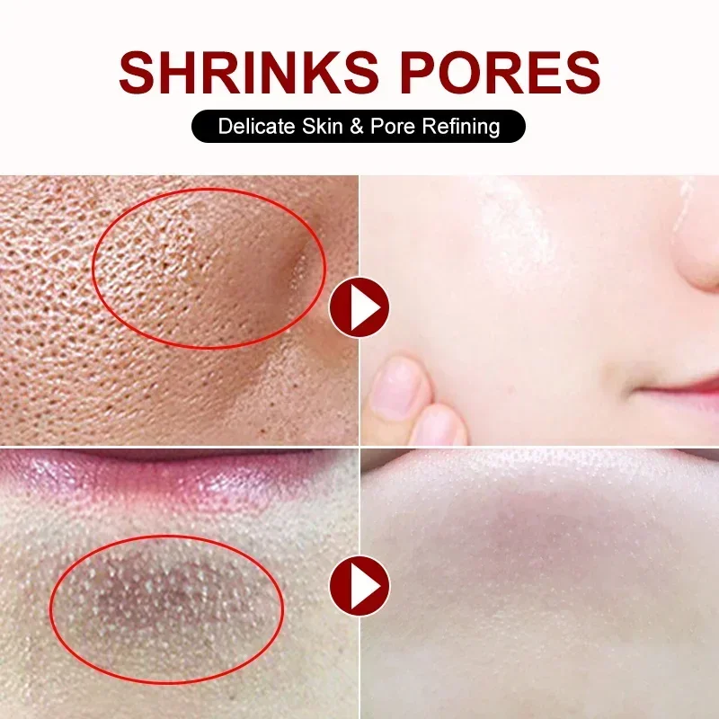 Salicylic Acid Pore Shrinking  - Azelaic Acid Cream reseña y precio
