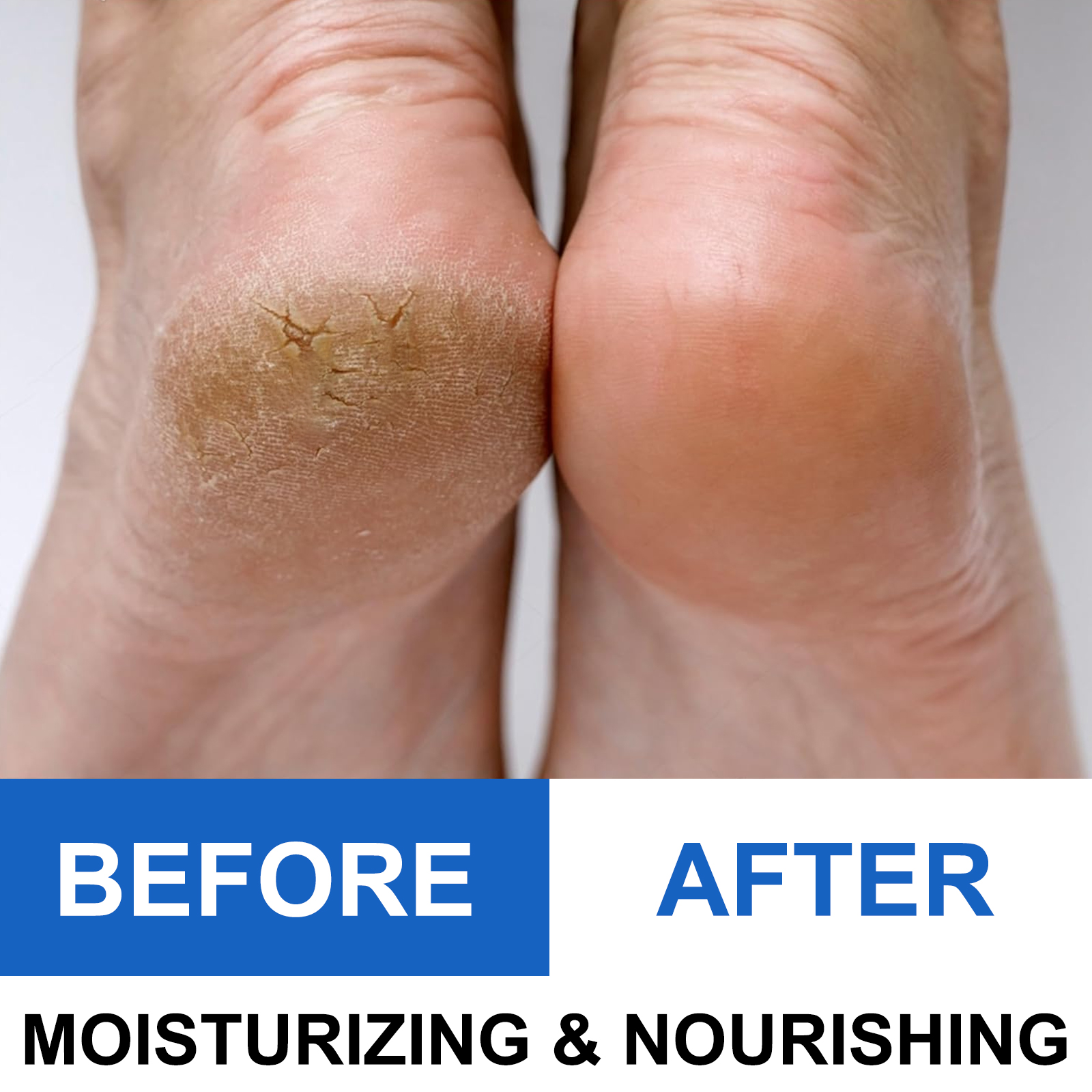 40% Urea Foot Cream Stick - Mo - Azelaic Acid Cream reseña y precio